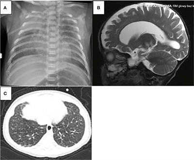 National experience with adenosine deaminase deficiency related SCID in Polish children